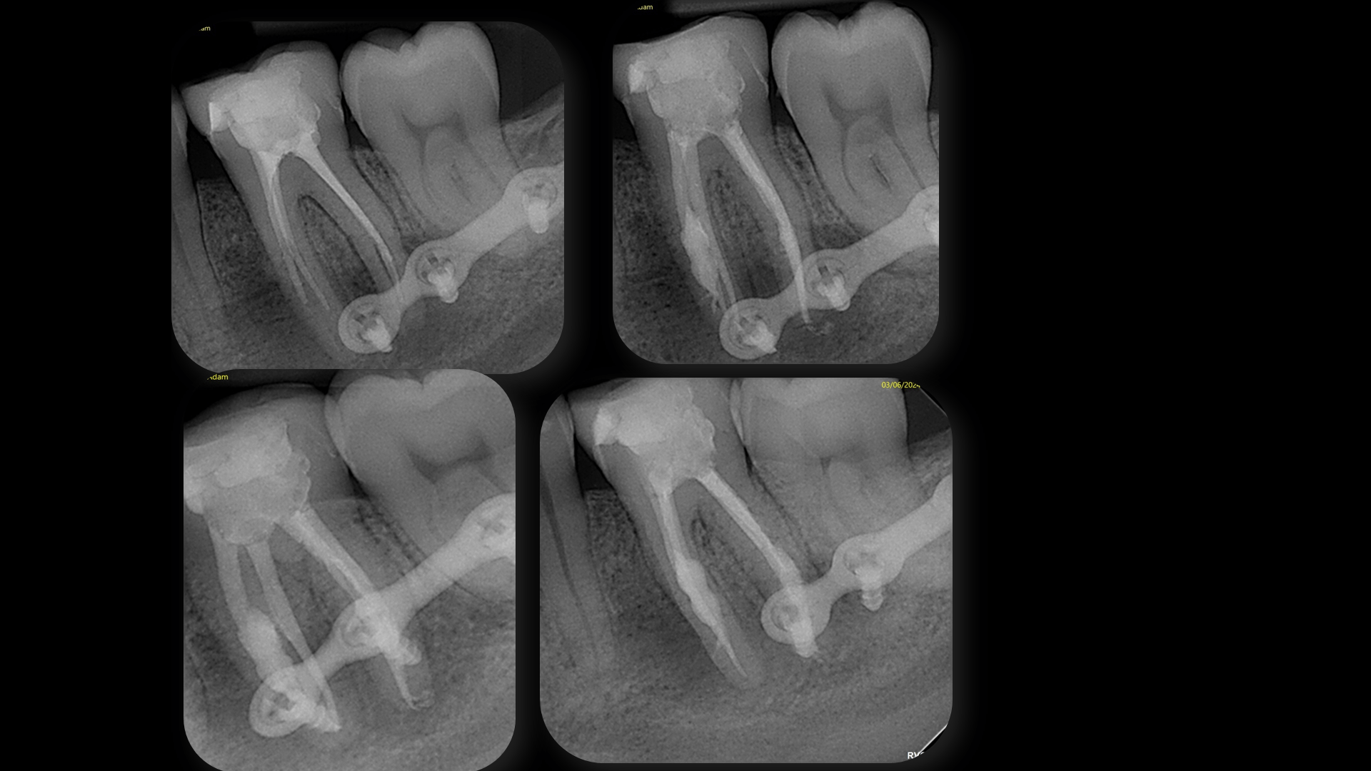 Complex Anatomy - Case 18
